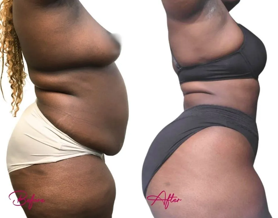 Awake Liposuction - Case 11