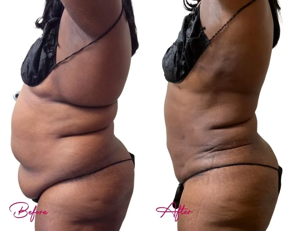 Awake Liposuction - Case 13