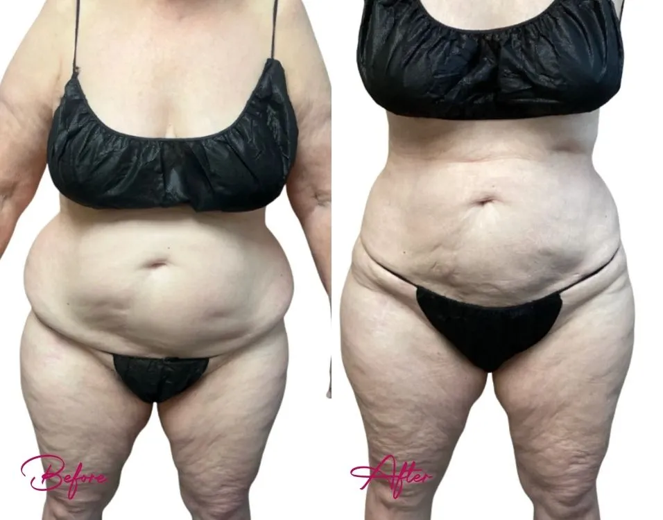 Awake Liposuction - Case 14