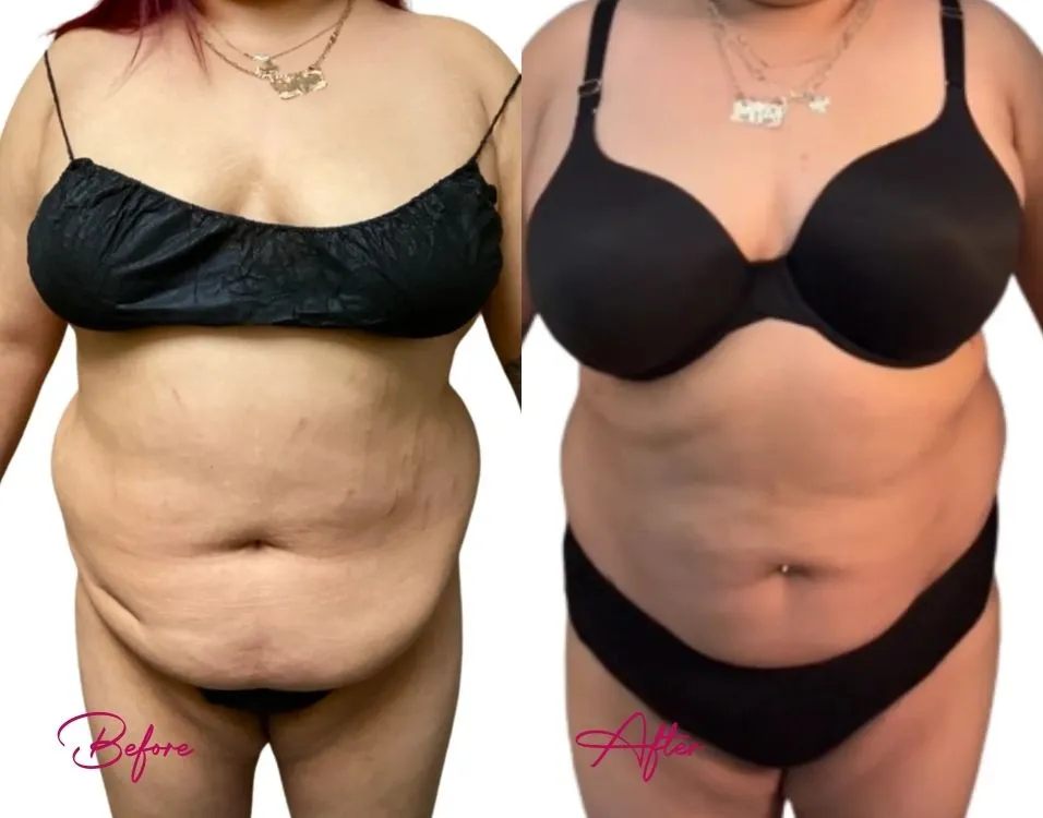 Awake Liposuction - Case 15