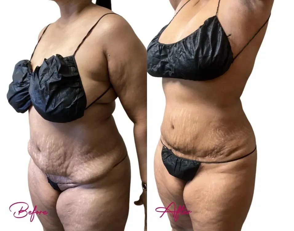 Awake Liposuction - Case 16