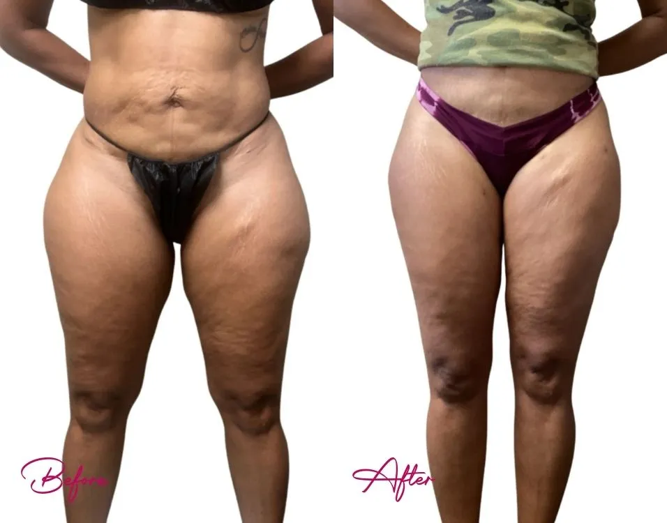 Awake Liposuction - Case 17