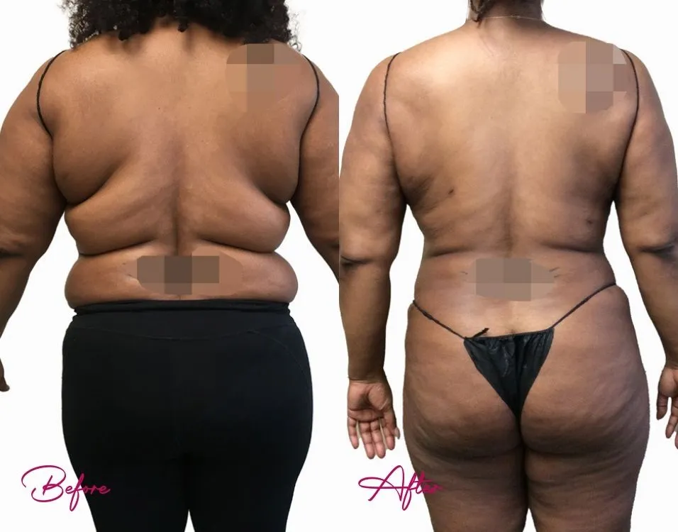 Awake Liposuction - Case 5