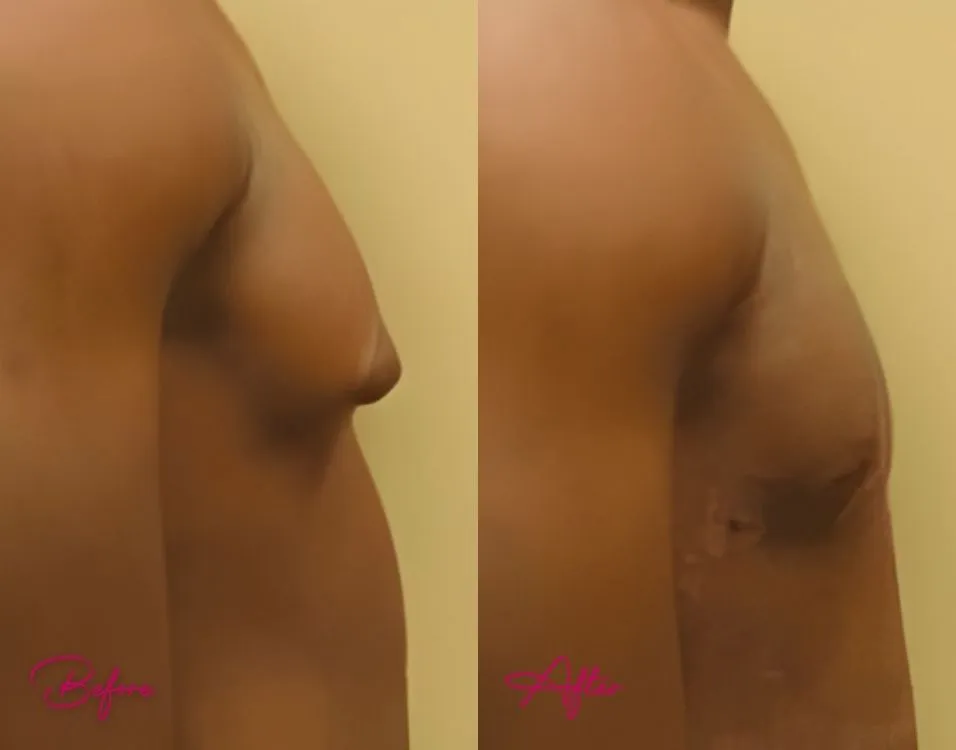 Gynecomastia - Case 1.1