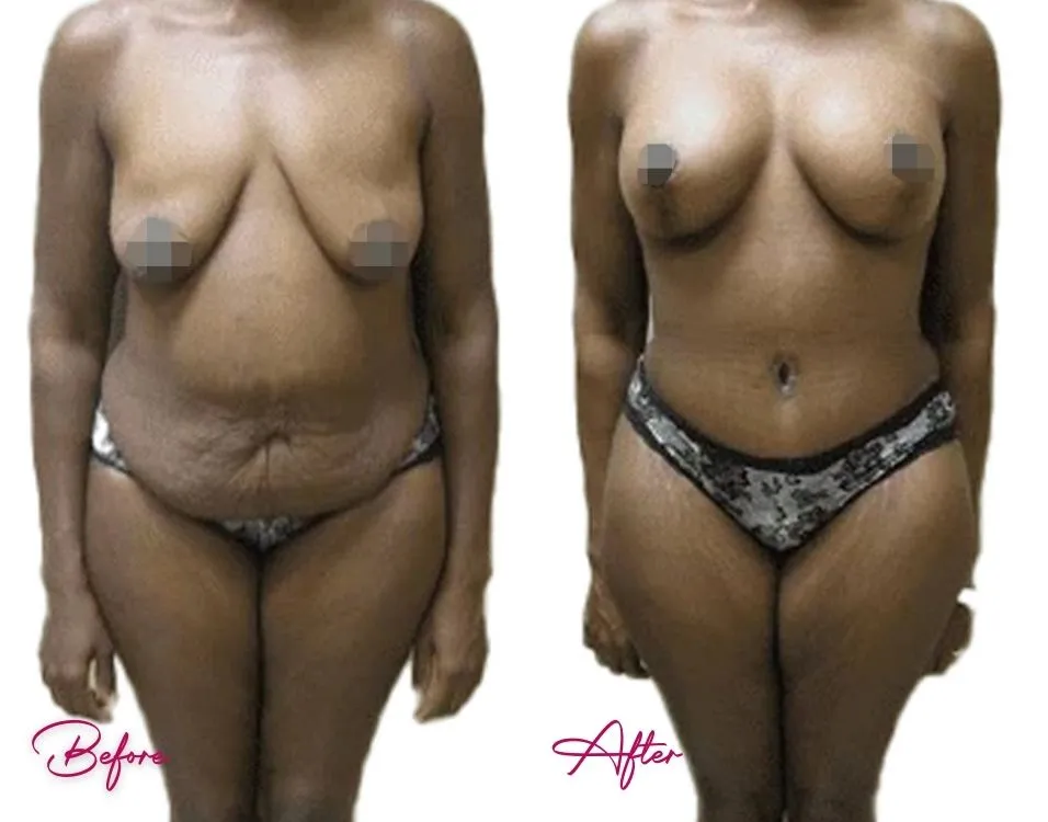 Tummy Tuck - Case 11