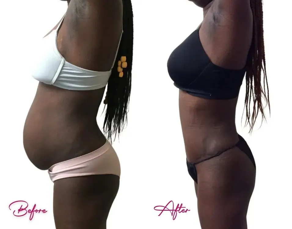 Tummy Tuck - Case 12