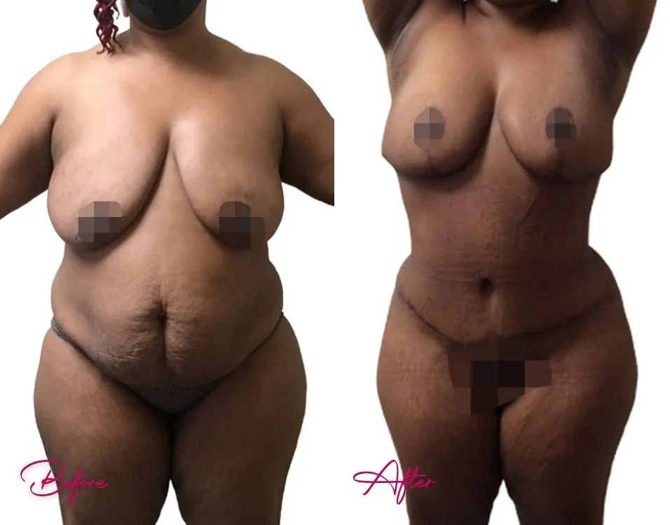 Tummy Tuck - Case 14