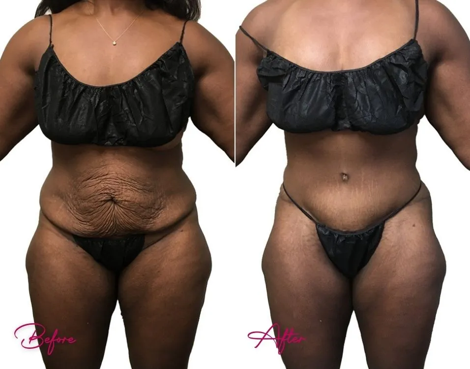 Tummy Tuck - Case 15