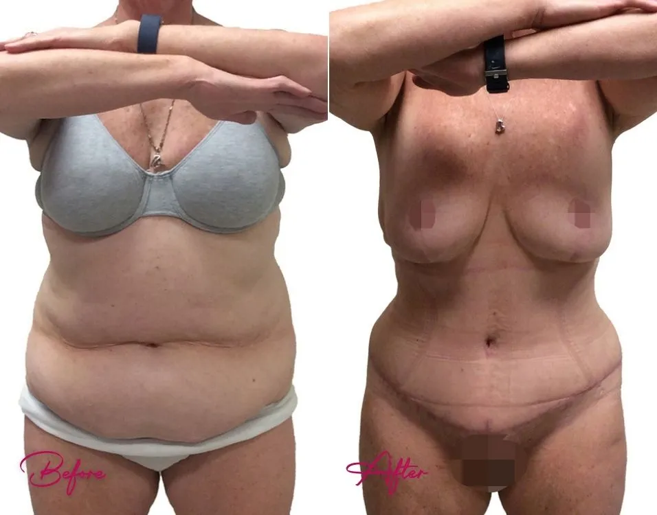 Tummy Tuck - Case 16