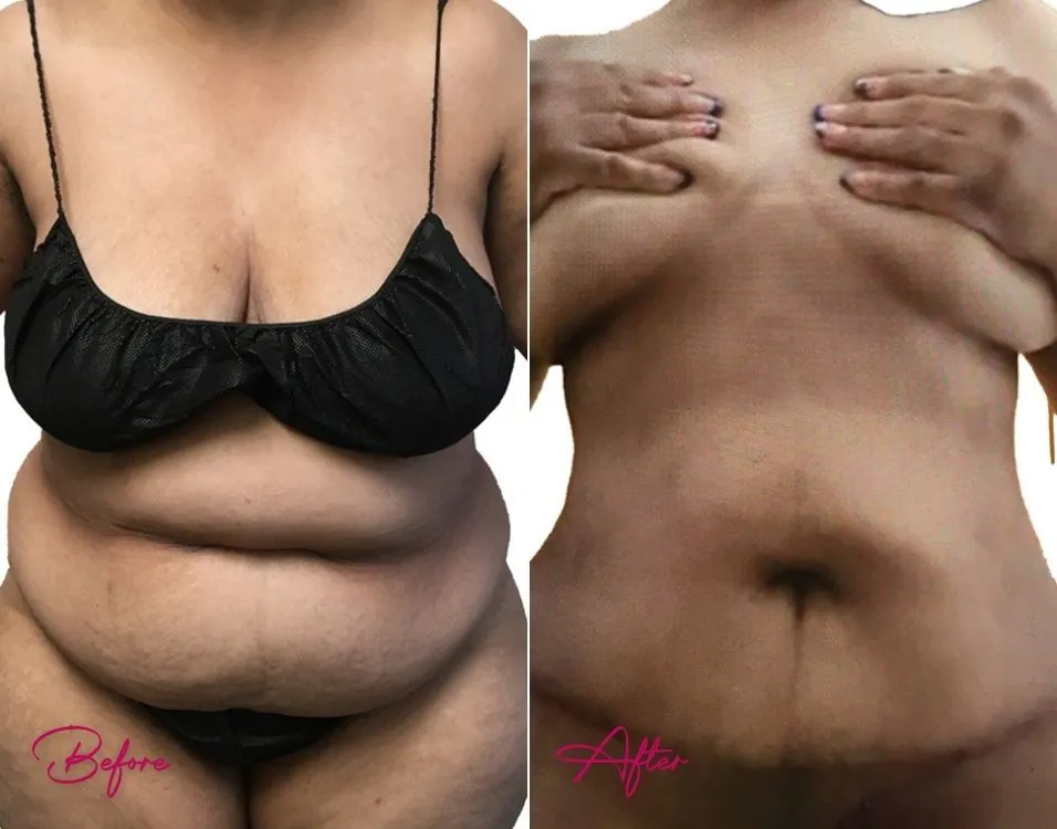 Tummy Tuck - Case 18