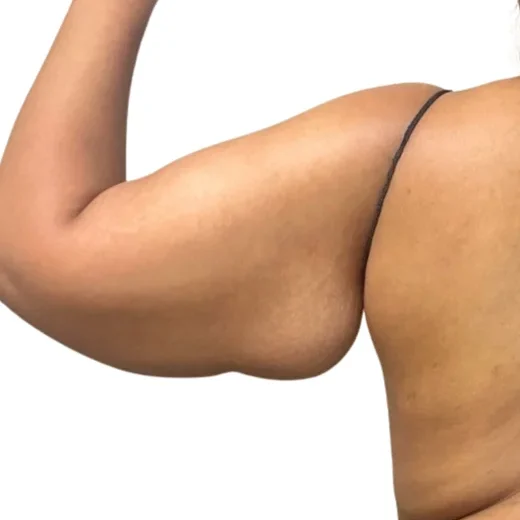 Awake Arm Lift Case 14577 Before